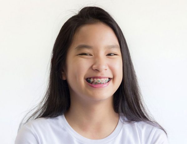 nan chinh rang cho tre em o do tuoi nao hieu qua nhat 600x461 1