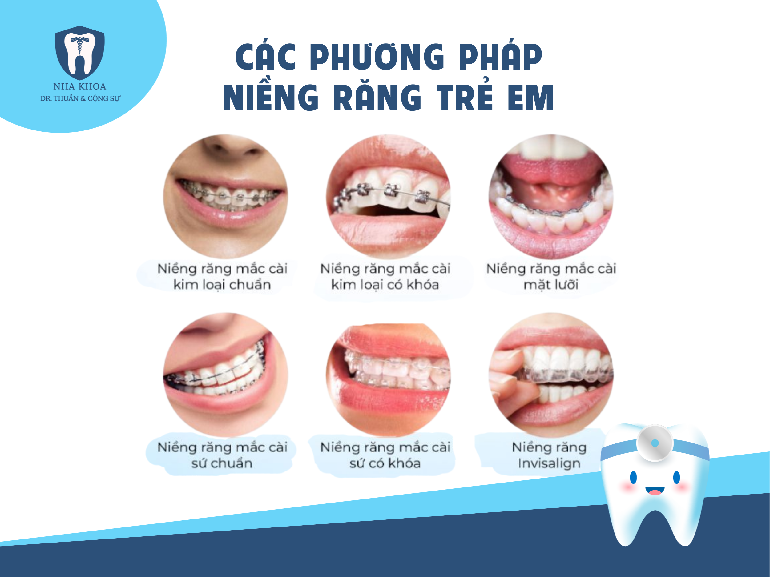 Các phương pháp niềng răng trẻ em