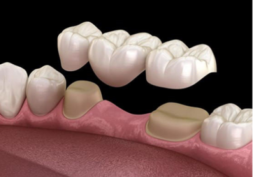 LÀM CẦU RĂNG SỨ CÓ BỀN KHÔNG? SỬ DỤNG ĐƯỢC BAO LÂU?