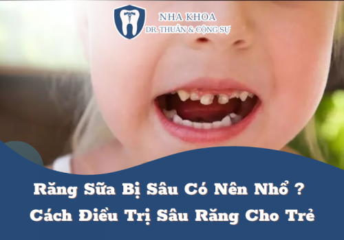 Răng Sữa Bị Sâu Có Nên Nhổ? Cách Điều Trị Sâu Răng Cho Trẻ