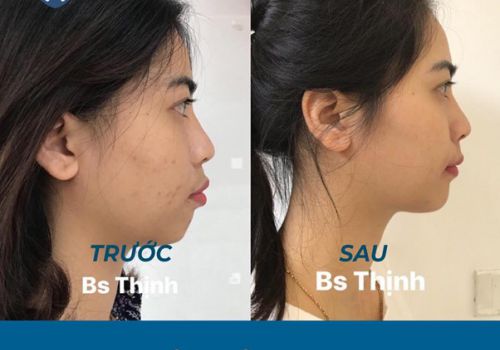 Review kinh nghiệm niềng răng thực tế và chi tiết