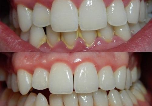 Bật mí: Kinh nghiệm chữa viêm nha chu thực tế