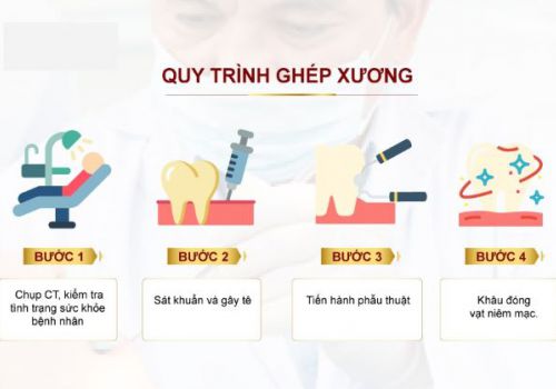 Những Điều Cần Biết Về Ghép Xương Trong Implant