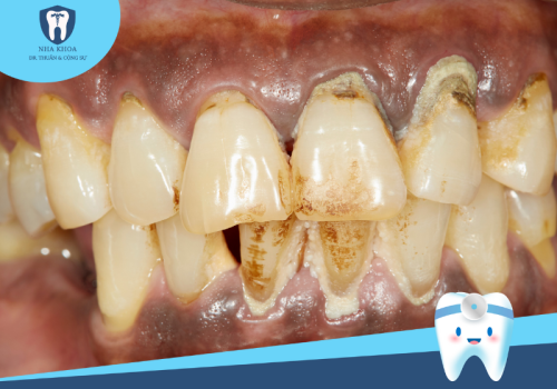 Viêm nha chu là gì? Cách chữa trị viêm nha chu hiệu quả