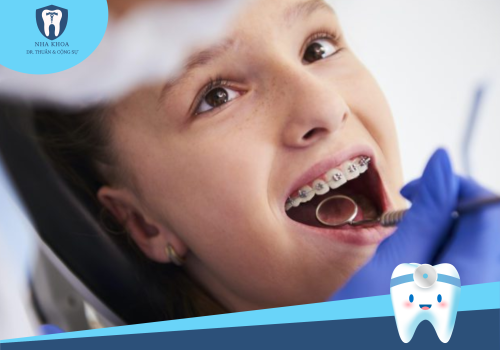 Mắc cài tự buộc và mắc cài thường kim loại giống và khác nhau thế nào?