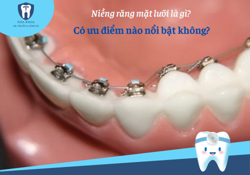 Niềng răng mặt lưỡi là phương pháp gì? Có ưu điểm nào nổi bật không?