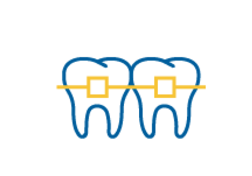 Niềng răng mắc cài