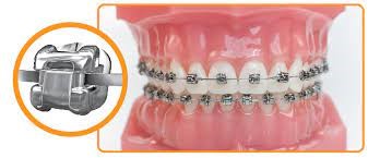 Niềng răng mắc cài 10 mac cai 2