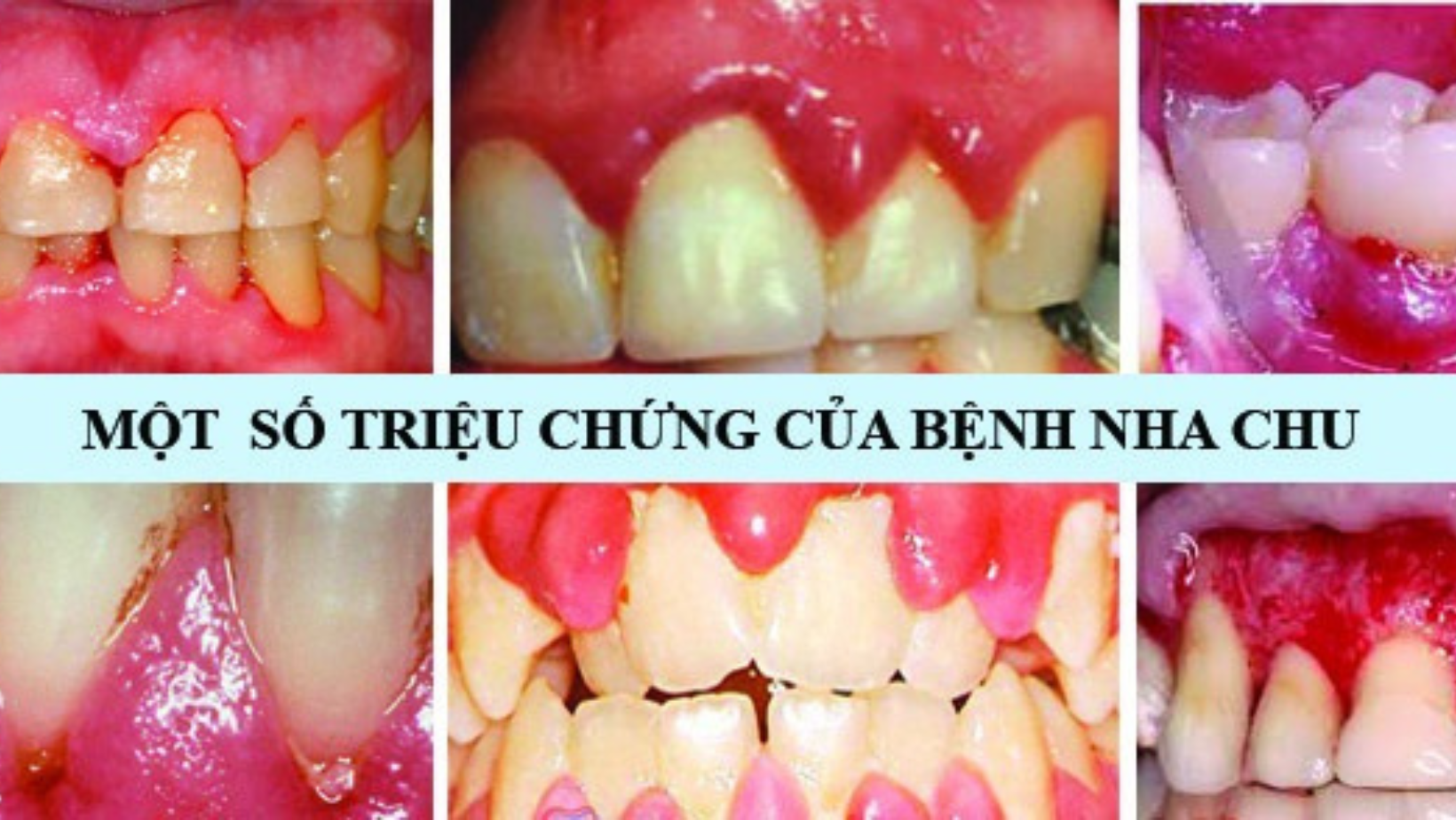 điều trị nha nhu