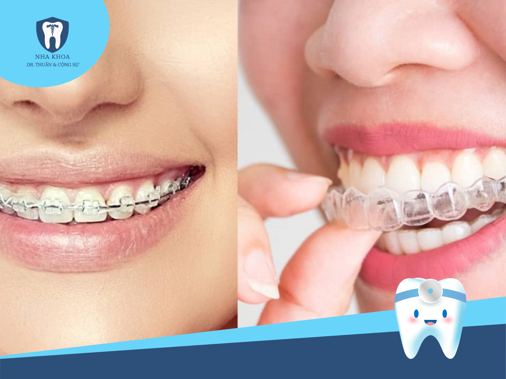 Niềng răng mắc cài trong suốt không chỉ hiệu quả mà còn đảm bảo an toàn, không gây kích ứng, phù hợp với những người dị ứng với kim loại.