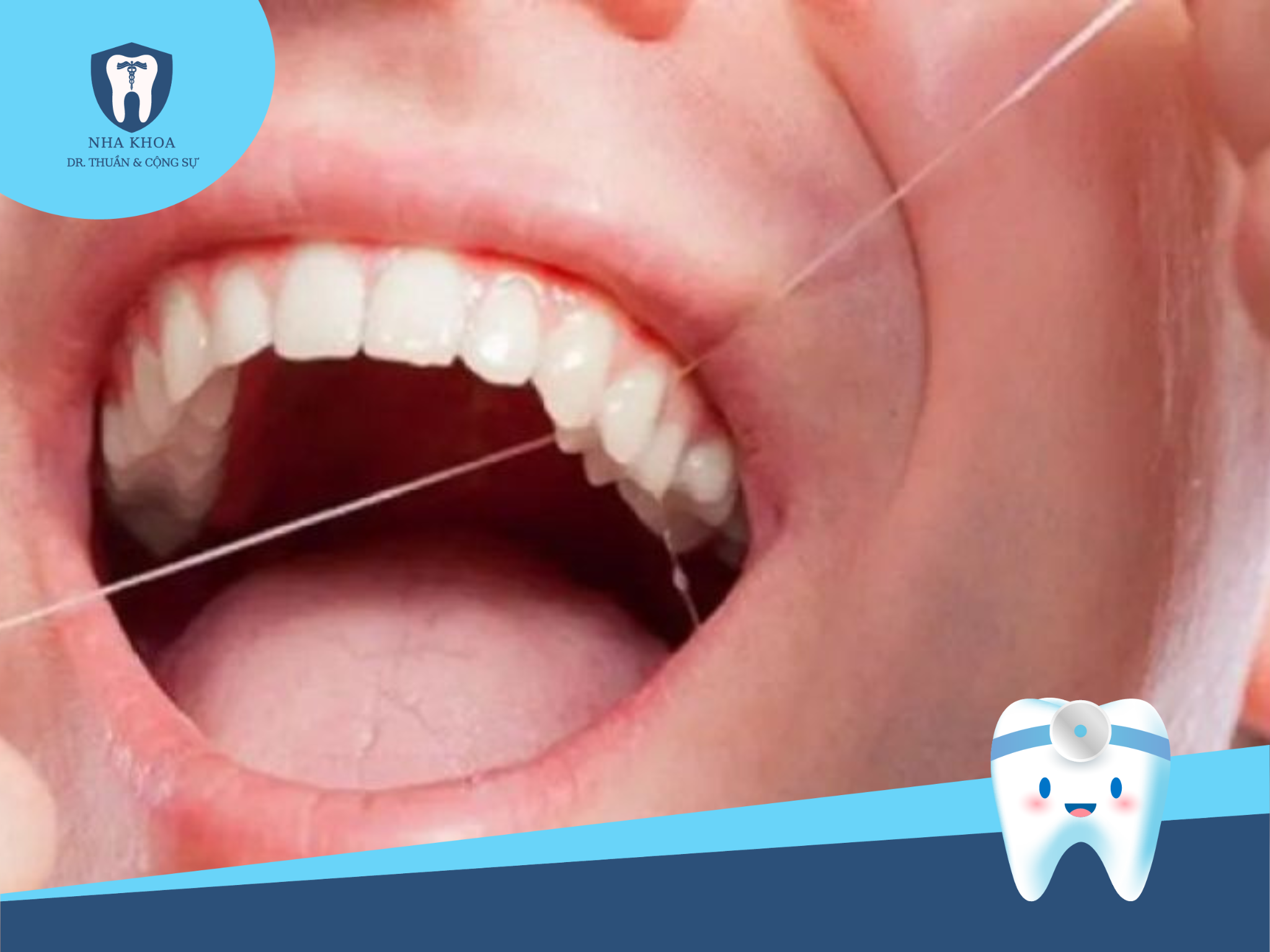 Những chú ý trong thời gian đeo niềng trong suốt