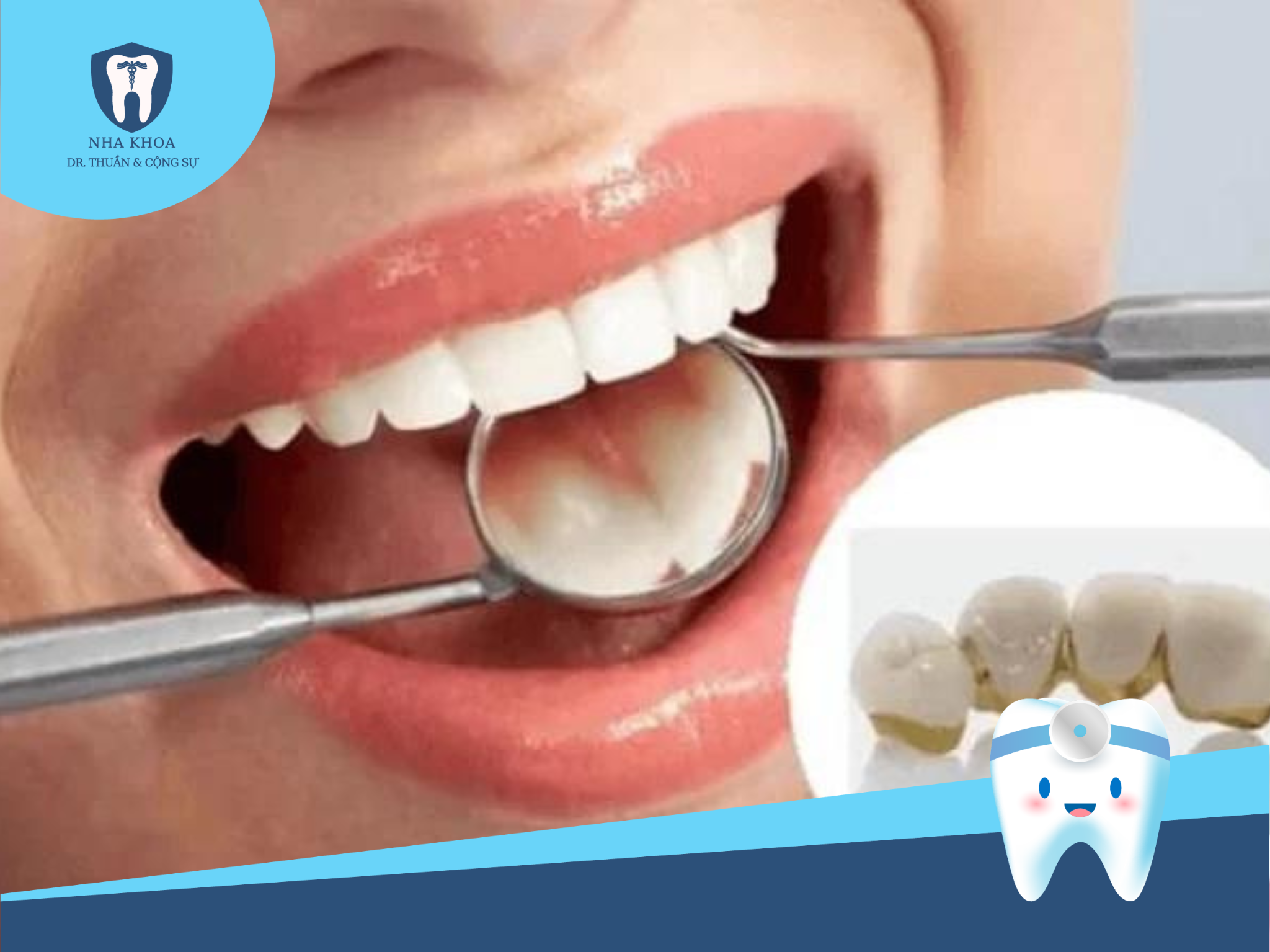 Để đạt hiệu quả cao và đảm bảo an toàn, quy trình bọc răng sứ thẩm mỹ phải được thực hiện đúng chuẩn theo trình tự và đầy đủ các bước.