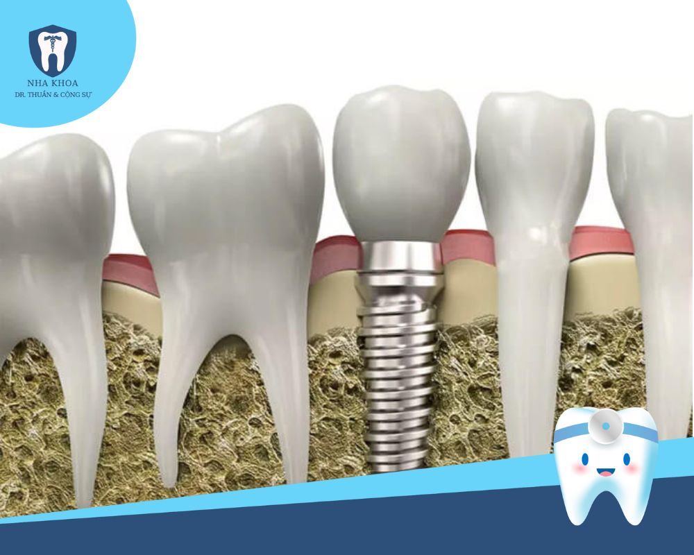 u điểm trụ implant dentium hàn quốc